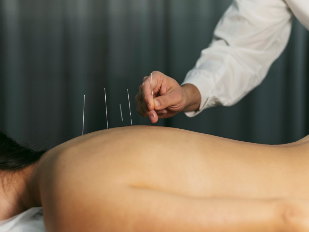 Acupuncture Therapy